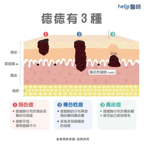 為什麼會長毛|痣變大、痣多或長毛會變皮膚癌？認識痣的形成與原因